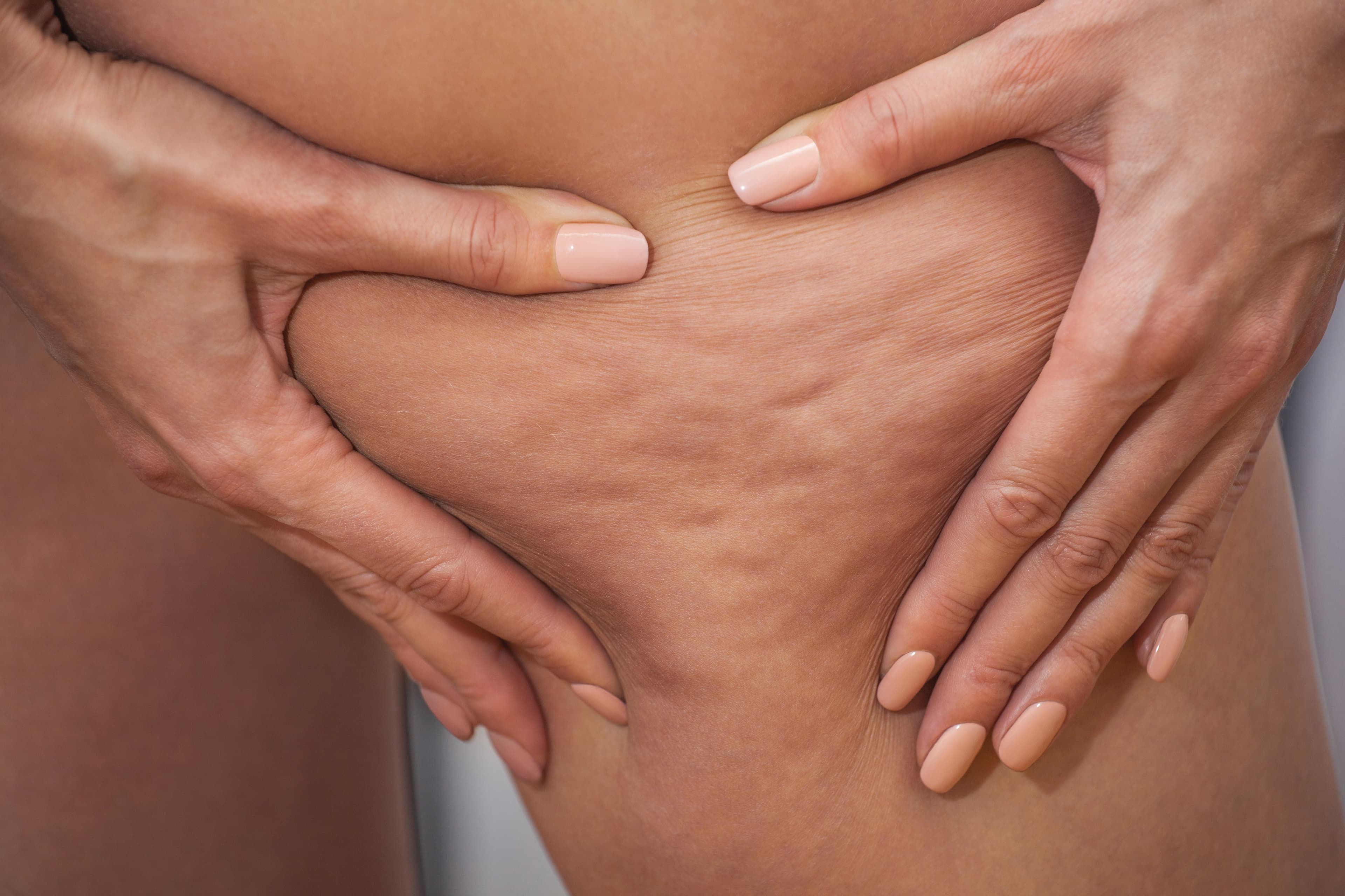 Comment réduire l'apparence de la cellulite naturellement ?
